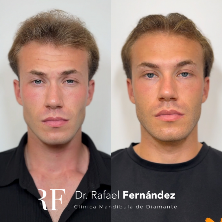 Mandíbula de Diamante - Masculinización Facial